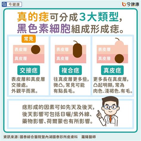 乳頭長痣|是痣or皮膚癌？醫「1張圖秒對照」 長這2部位最危險